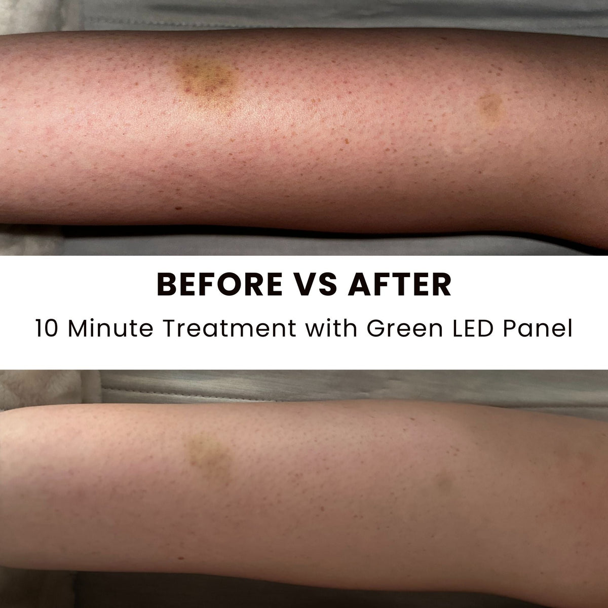 Before and after treatment of a person's leg with a green LED panel, showing skin discoloration reduction.