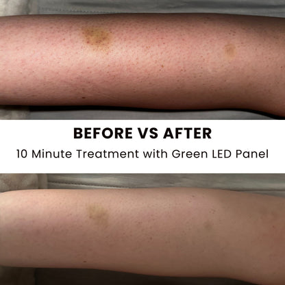 Before and after treatment of a person's leg with a green LED panel, showing skin discoloration reduction.